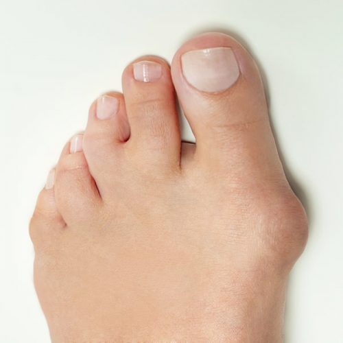 pic-services-bunions.jpg